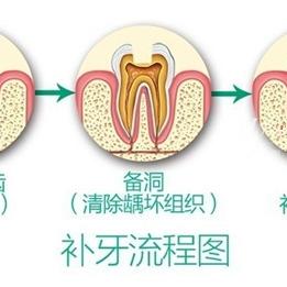最新补牙材料革新牙科技术